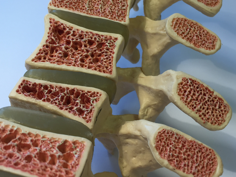 Anatomical model of Cross-section of spinal column and vertebral bodies showing different stages of osteoporosis