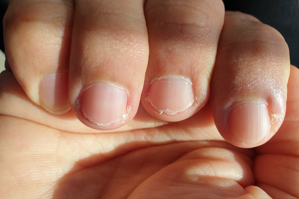 Close-up of brittle nails.