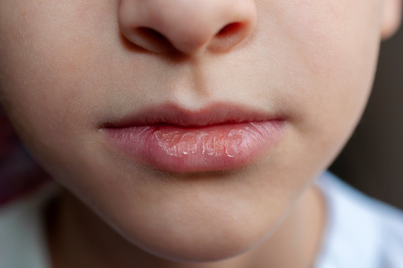 Closeup of Baby’s Dry Chapped Lips